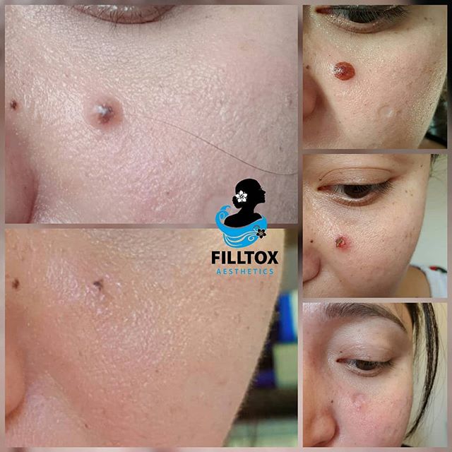 Pigmentation treatment stages showing darkening and flaking process